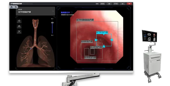 AI支气管内窥镜导航助手